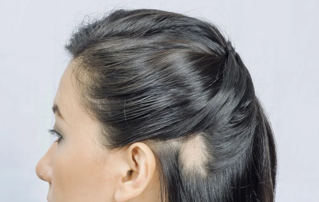 Alopecia Areata