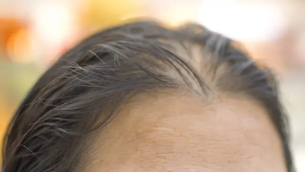 Menopause Hair Loss